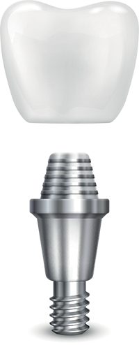 titanium dental implant
