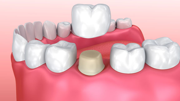 Dental Crowns and Bridges Flagstaff, AZ