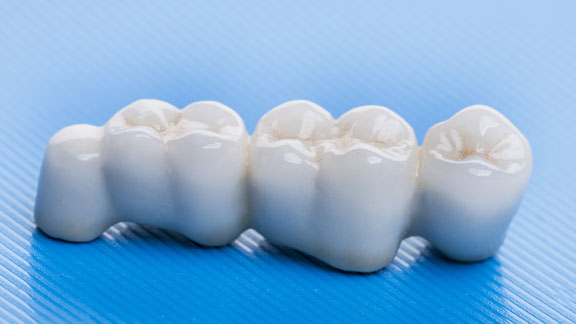 Dental Crowns and Bridges Flagstaff, AZ