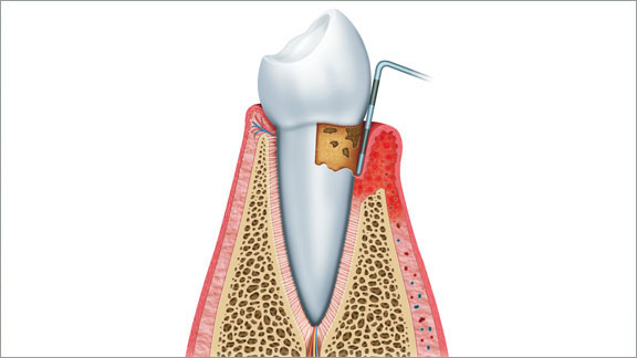 Periodontics Flagstaff, AZ